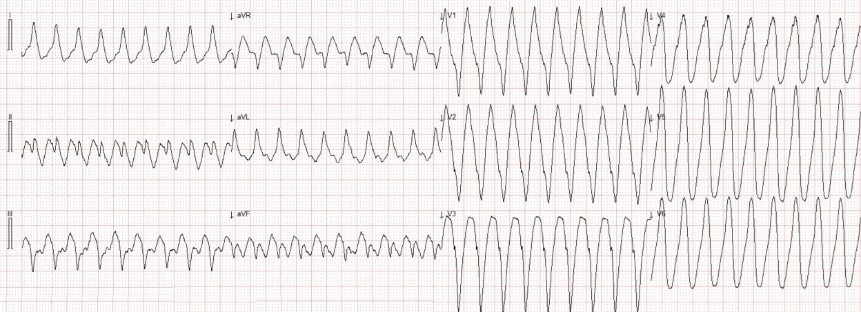 Electrophysiology: Wide Complex Tachycardia in a 70-something - Dr ...