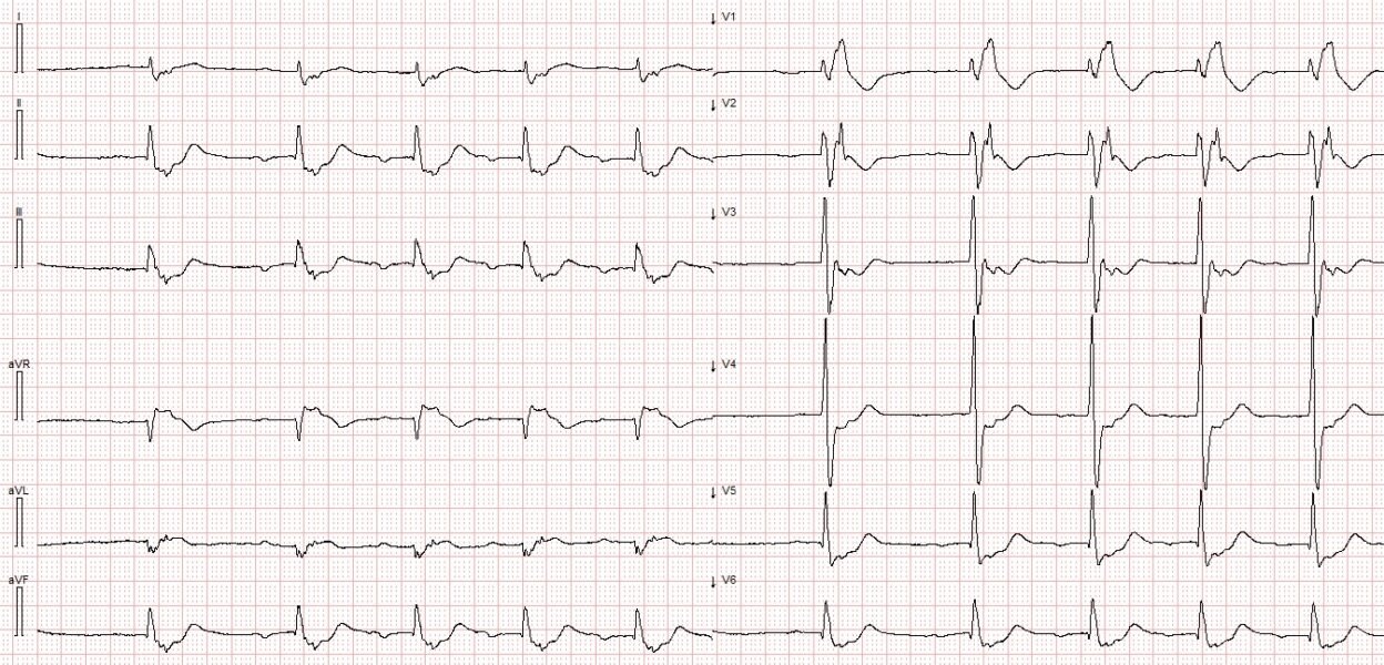 Wide Complex Ecg Rythm Electrophysiology: Wide Complex Tachycardia in a 70-something - Dr ...