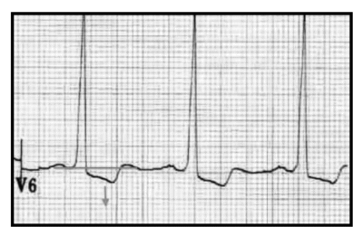 What do you make of these T wave inversions? - Dr. Smith’s ECG Blog