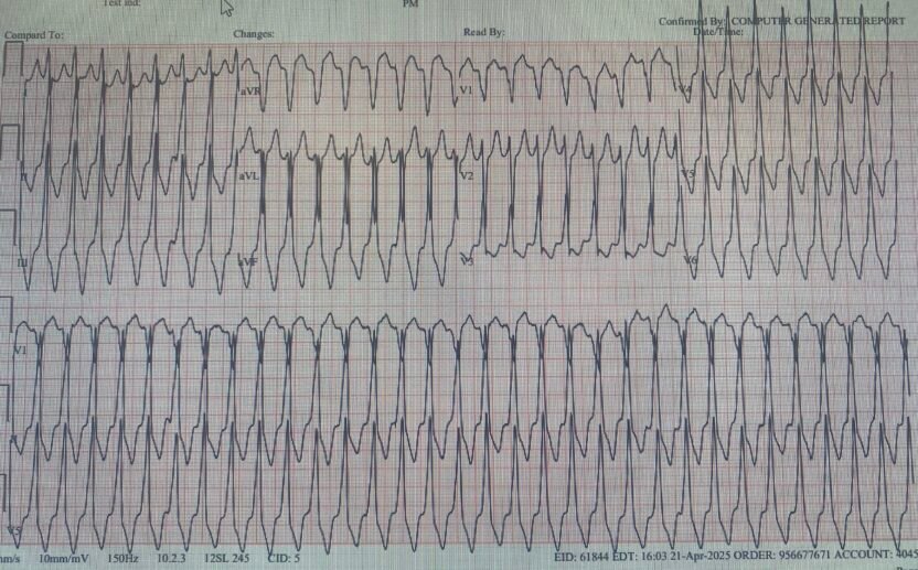 Wide Complex Tachycardia, intermittent - Dr. Smith’s ECG Blog