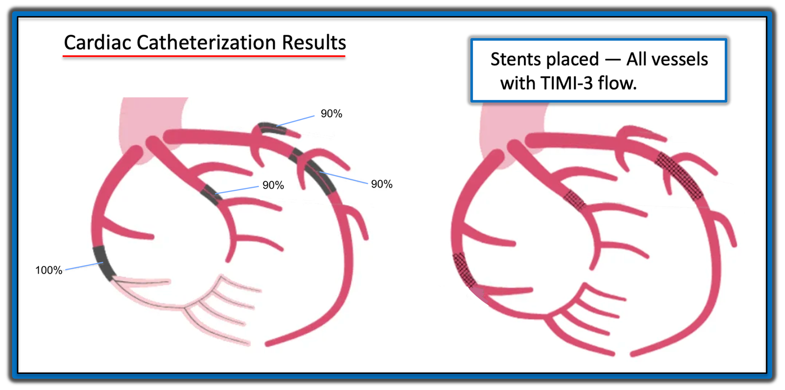 Is it Always Best to Activate when Convinced of Acute OMI in a STEMI ...