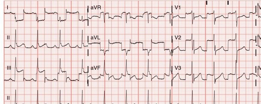 Acute chest pain and ST Elevation. Activate the cath lab? - Dr. Smith’s ...
