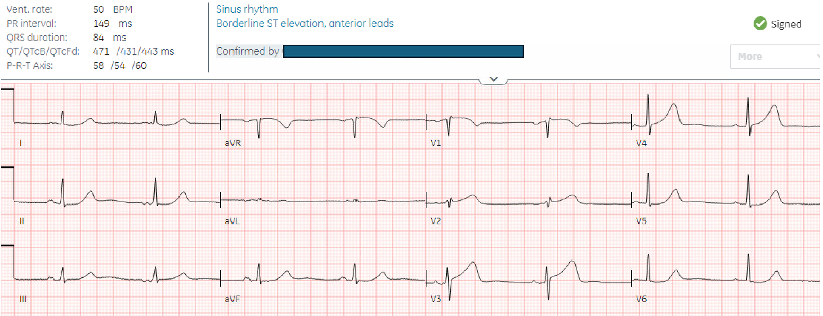 75 year old with acute chest pain: 6 bad reasons not to cath. - Dr