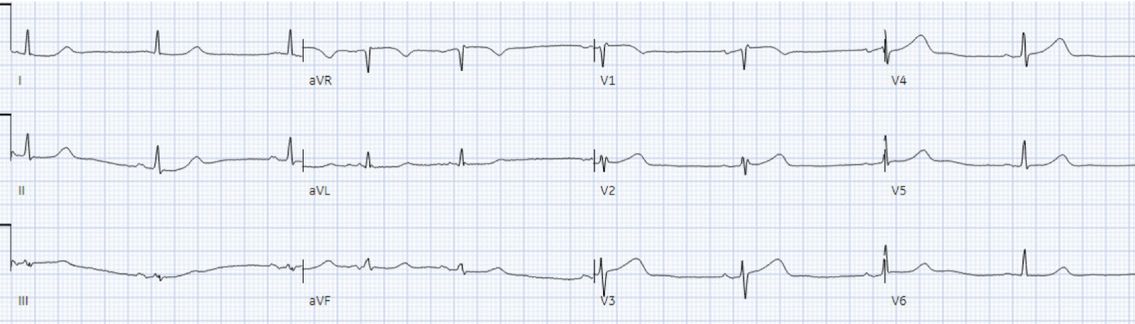 75 year old with acute chest pain: 6 bad reasons not to cath. - Dr ...