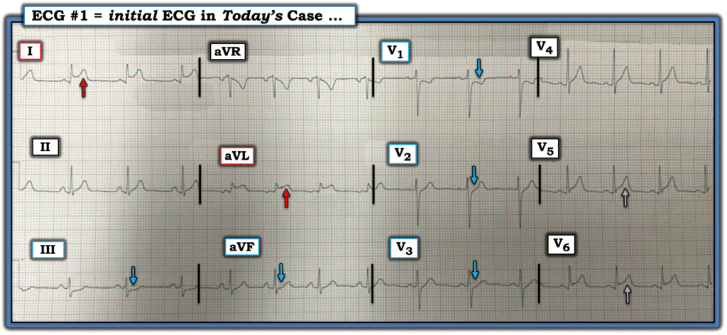 This image has an empty alt attribute; its file name is Figure-1-ECG-1-8-24.32-2025-USE-1024x472.png