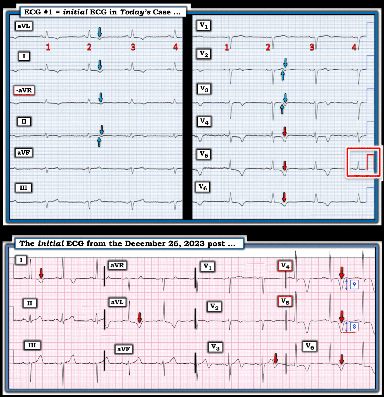 What do you make of these T wave inversions? - Dr. Smith’s ECG Blog