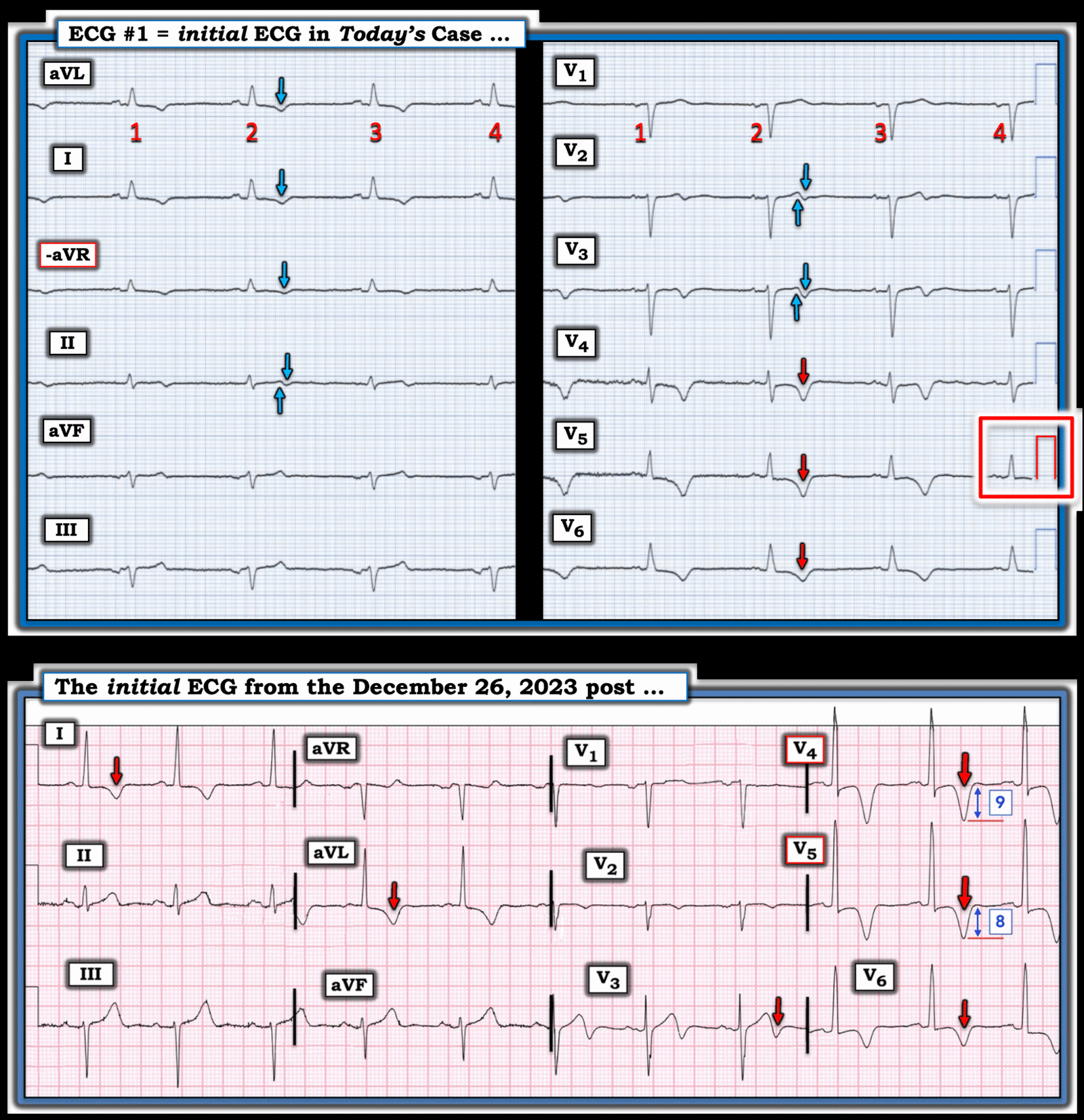 What do you make of these T wave inversions? - Dr. Smith’s ECG Blog