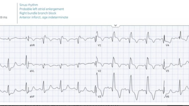 Post Rosc Mi Ecg A 35-year old woman with this post-ROSC ECG. What does