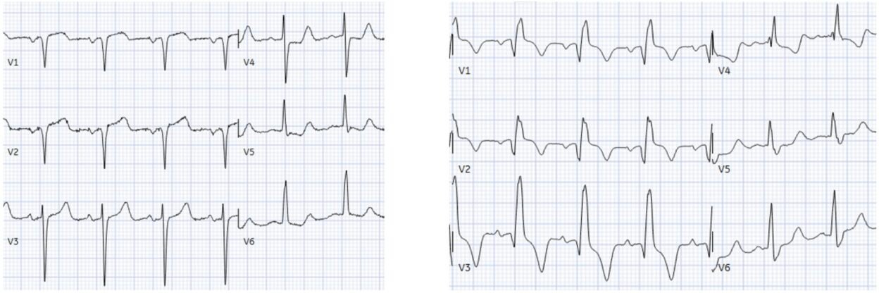 Chest pain with acute RBBB: just another NSTEMI? - Dr. Smith’s ECG Blog