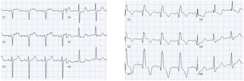 Chest pain with acute RBBB: just another NSTEMI? - Dr. Smith’s ECG Blog