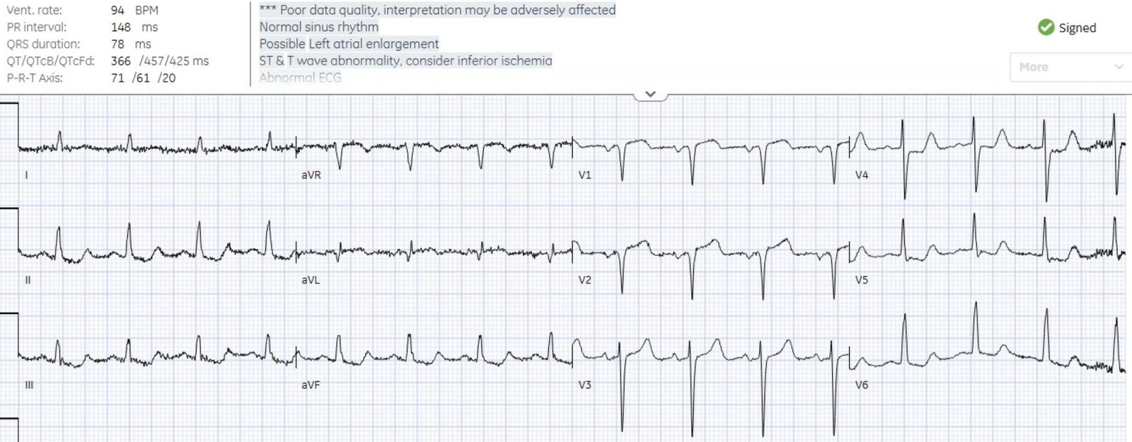 Chest pain with acute RBBB: just another NSTEMI? - Dr. Smith’s ECG Blog