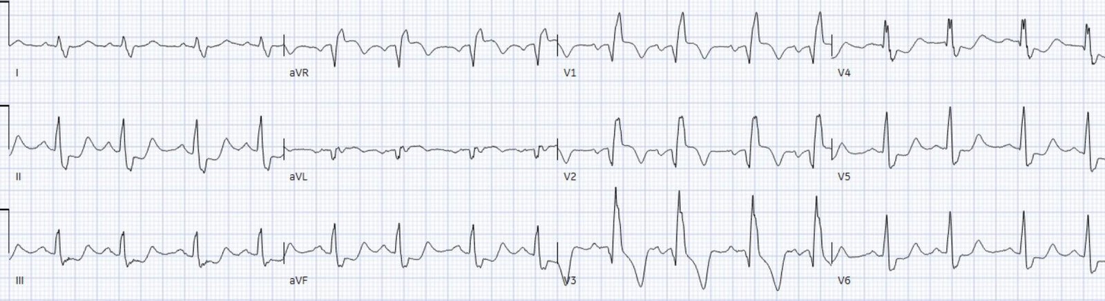 Chest pain with acute RBBB: just another NSTEMI? - Dr. Smith’s ECG Blog
