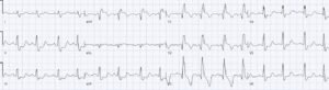 Chest pain with acute RBBB: just another NSTEMI? - Dr. Smith’s ECG Blog