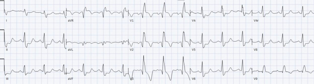 Chest pain with acute RBBB: just another NSTEMI? - Dr. Smith’s ECG Blog