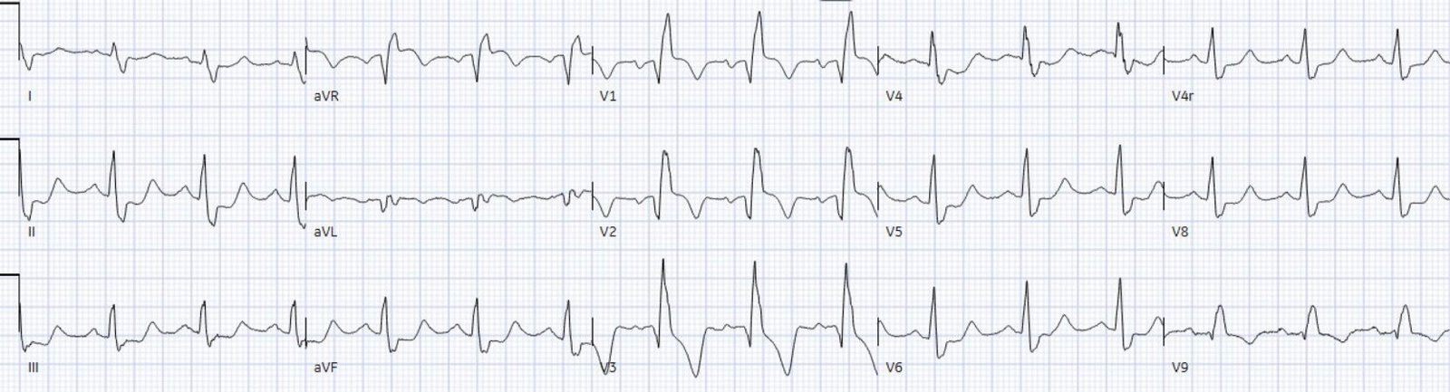 Chest pain with acute RBBB: just another NSTEMI? - Dr. Smith’s ECG Blog