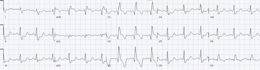 Chest pain with acute RBBB: just another NSTEMI? - Dr. Smith’s ECG Blog