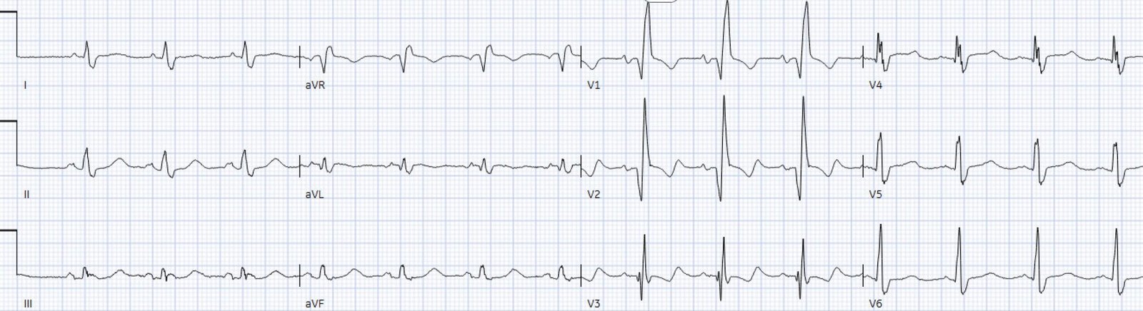 Chest pain with acute RBBB: just another NSTEMI? - Dr. Smith’s ECG Blog