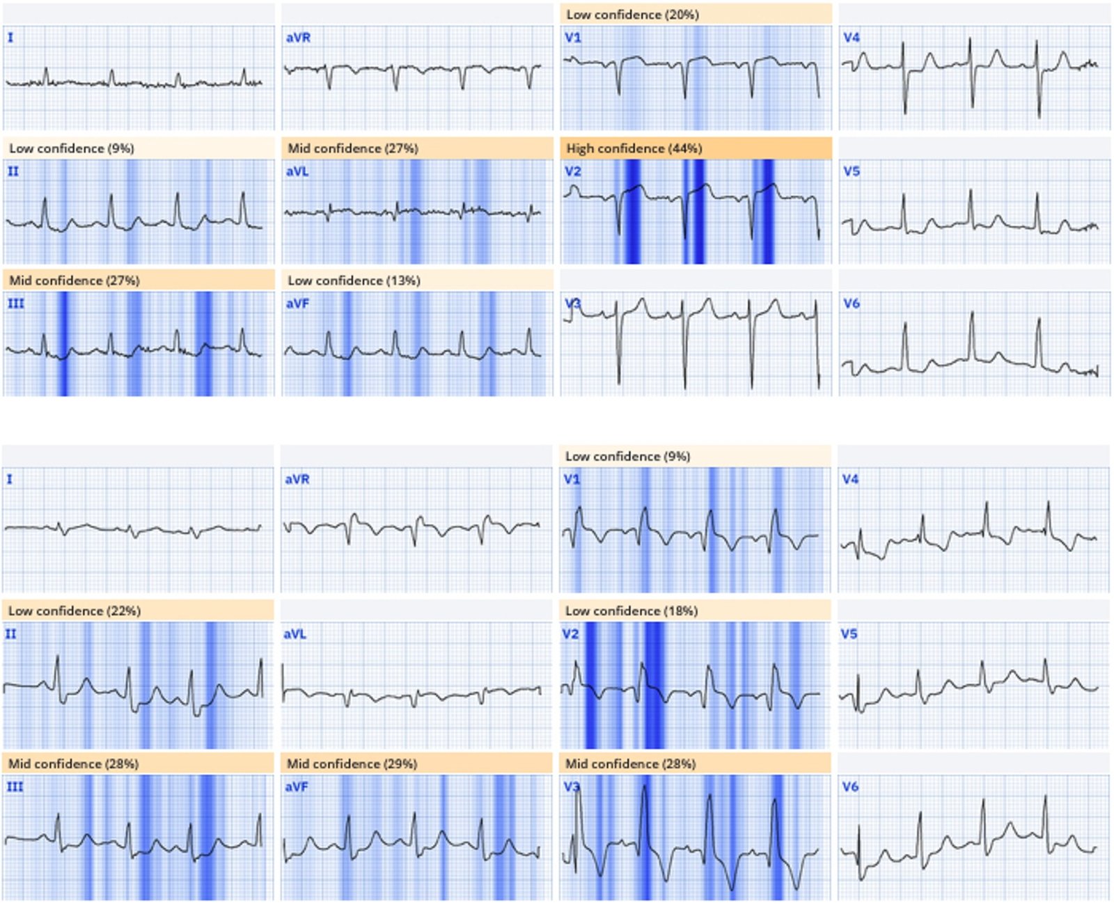 Chest pain with acute RBBB: just another NSTEMI? - Dr. Smith’s ECG Blog
