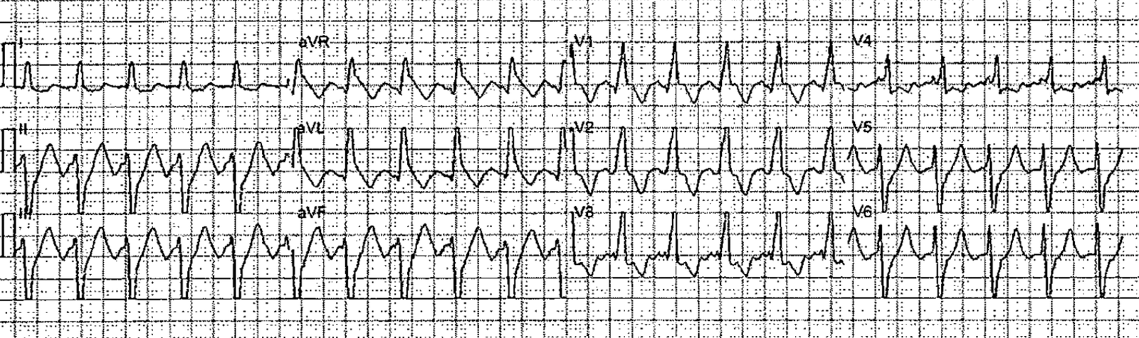 Wide complex Tachycardia in an 85 year old - Dr. Smith's ECG Blog