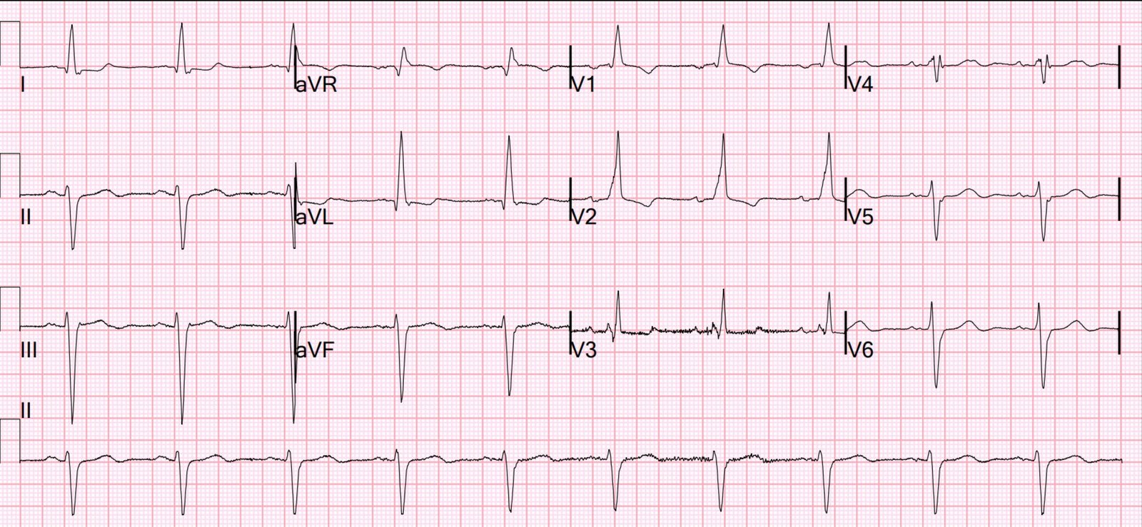 Wide Complex Ecg Rythm Wide complex Tachycardia in an 85 year old - Dr. Smith’s ECG Blog