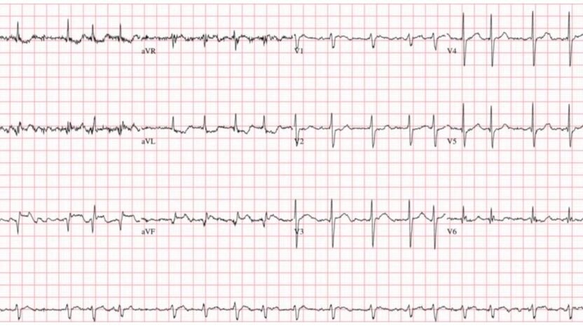 Atrial fibrillation with RVR and ST depression: POCUS, cardioversion ...