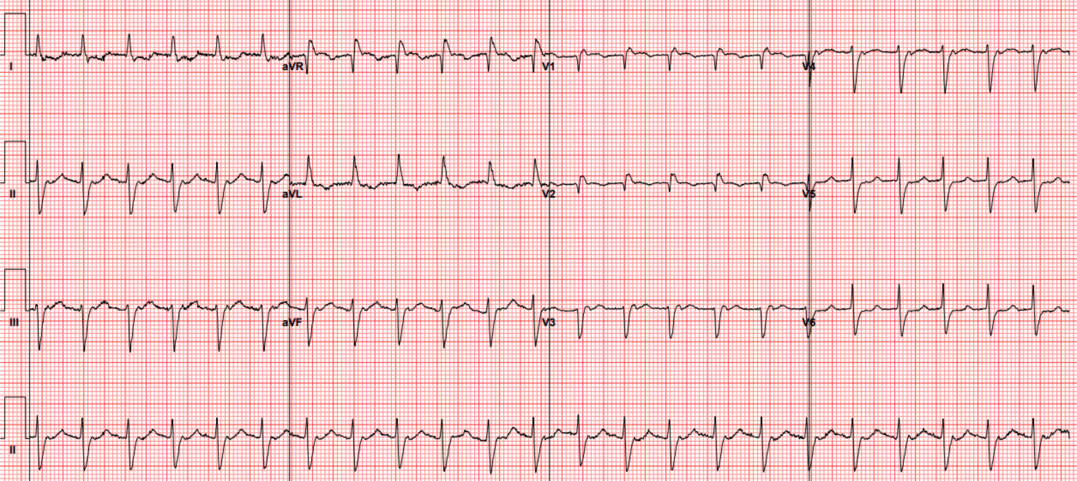 Narrow complex tachycardia, with interesting laddergram - Dr. Smith’s ...