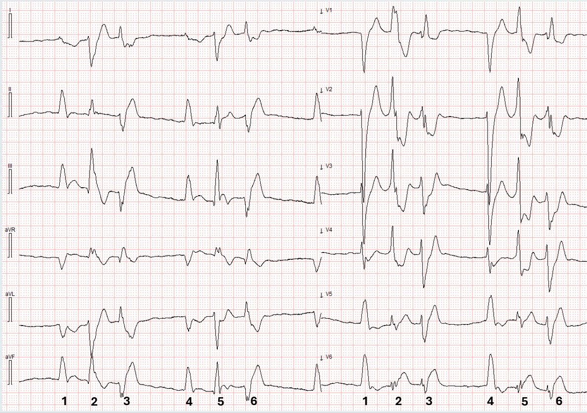 Wide Complex Ecg Rythm Fascinating Wide Complex Tachycardia and instructive ECGs during chest ...