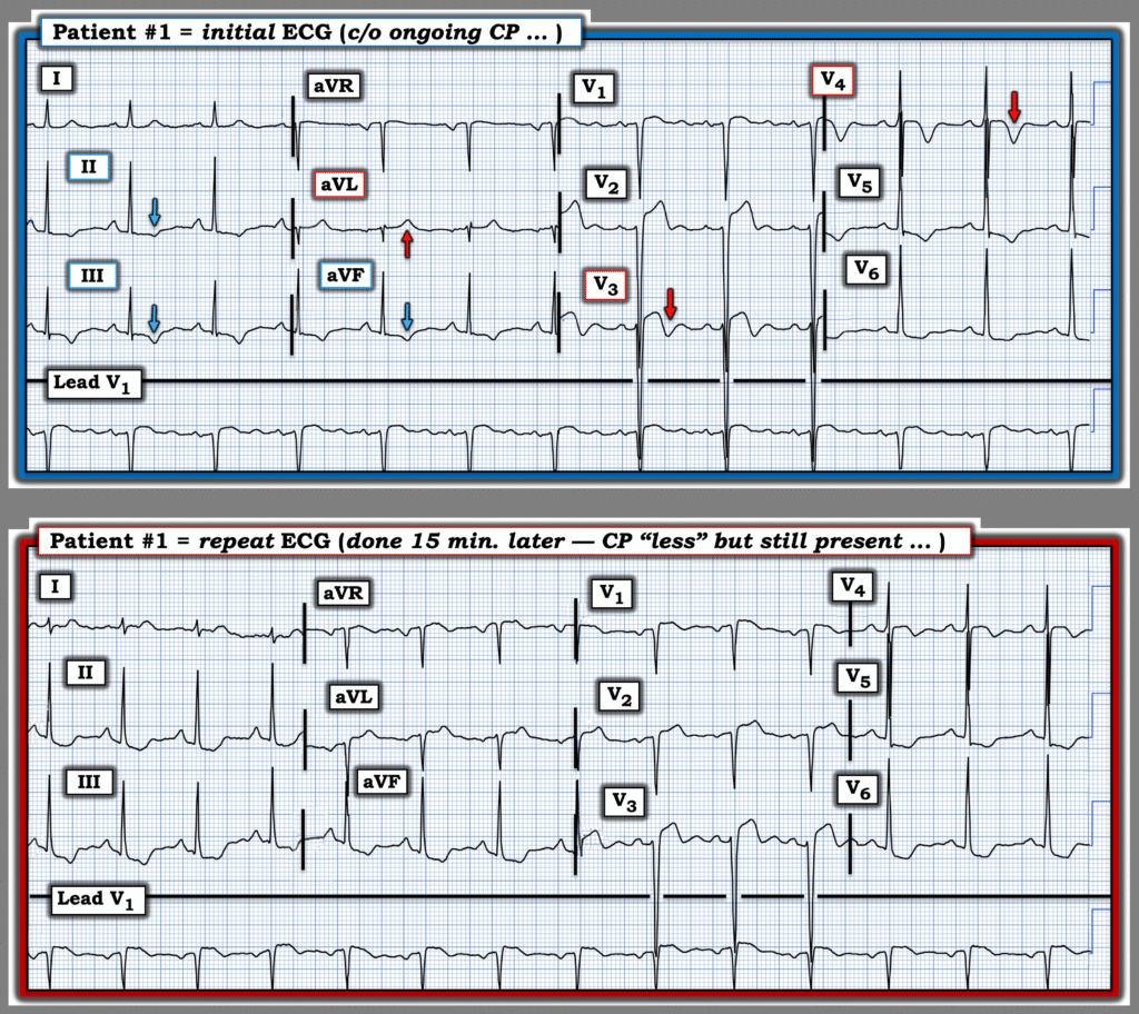 This image has an empty alt attribute; its file name is Figure-1-Patient-1-ECGs-12-11-23.44-2025-USE-1024x912.png