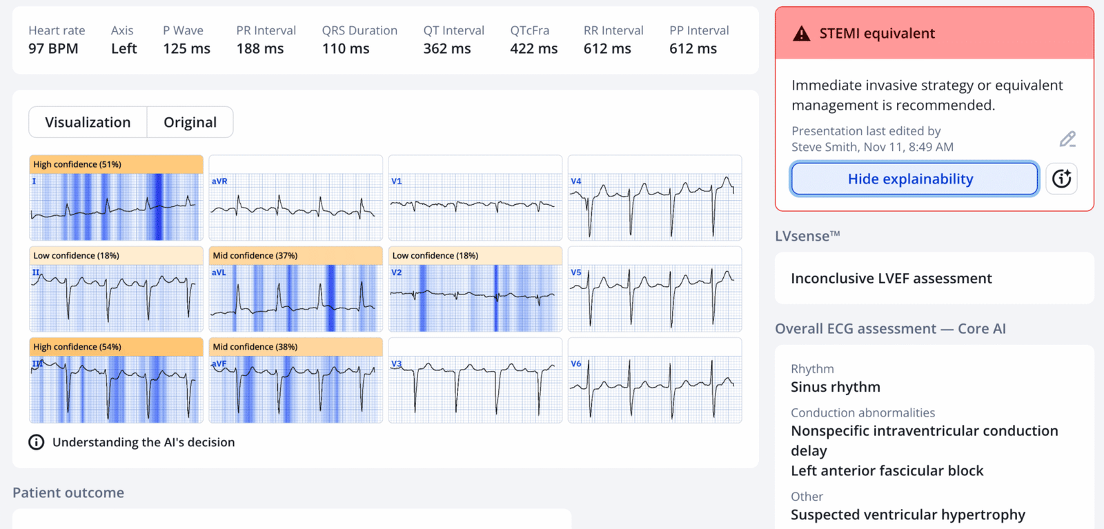 Chest pain, serial ECGs STEMI negative, first troponin normal: cancel ...
