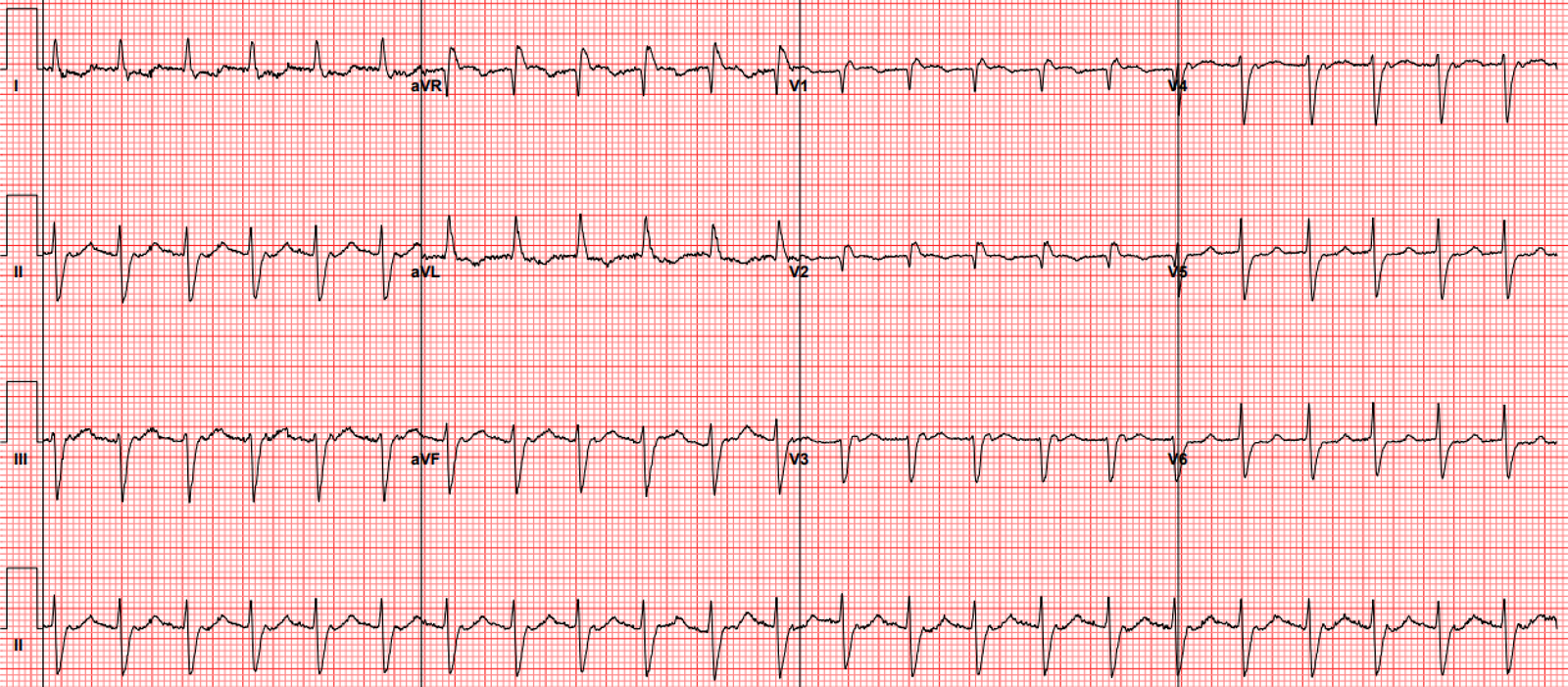 Narrow complex tachycardia, with interesting laddergram - Dr