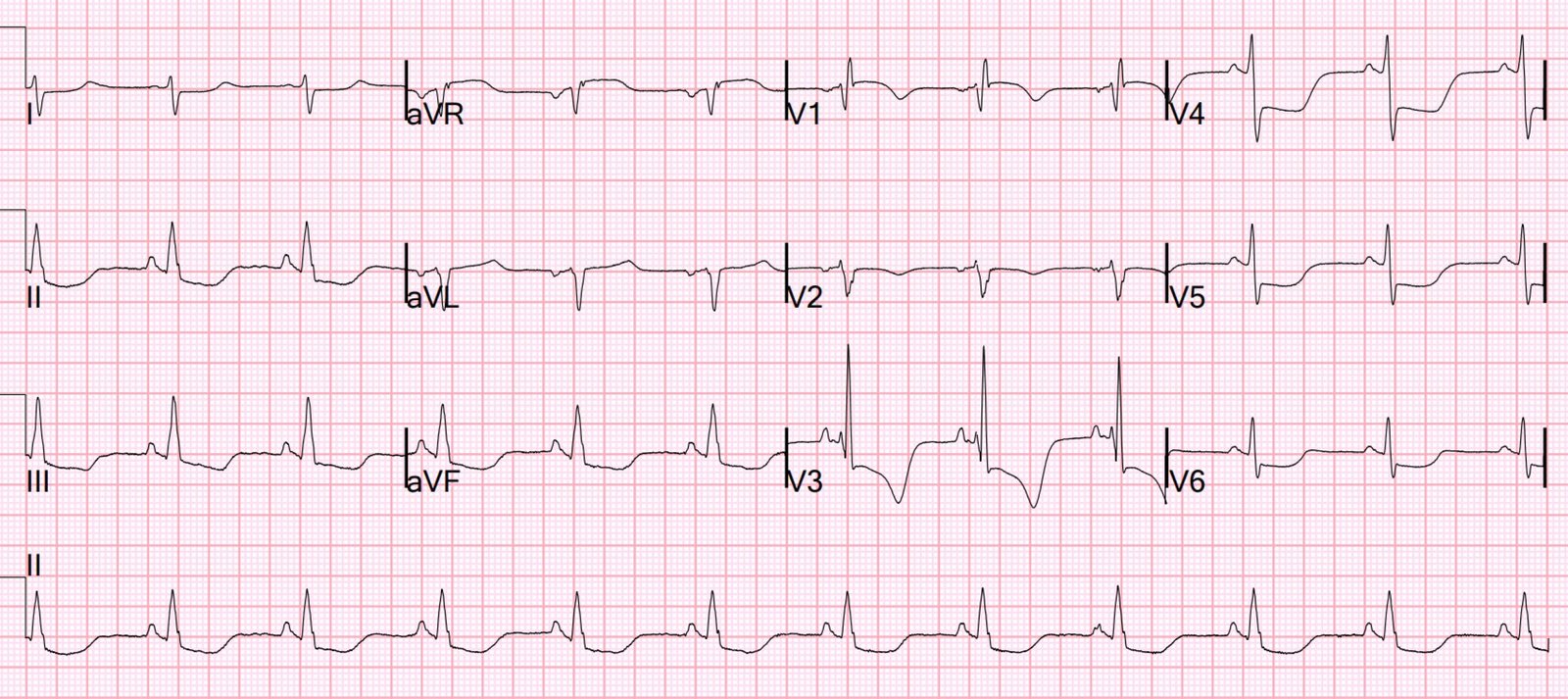 Post Rosc Mi Ecg COPD exacerbation, followed by cardiac arrest. - Dr. Smith’s ECG Blog
