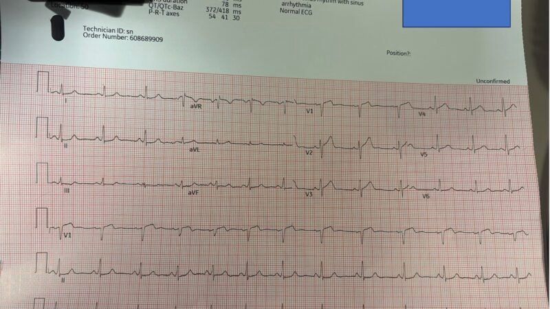 What do you make of these T wave inversions? - Dr. Smith’s ECG Blog