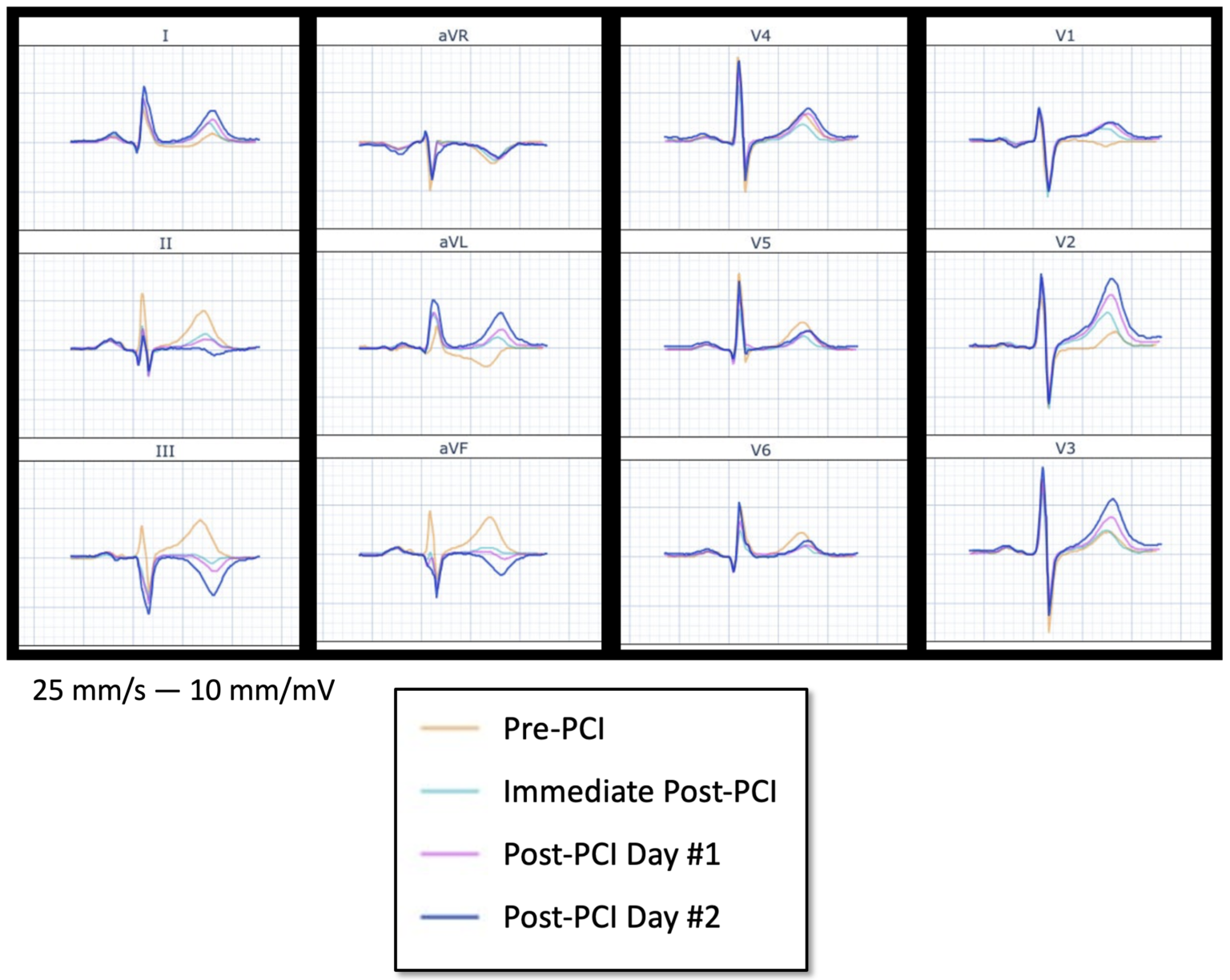 Reciprocally Inverted Hyperacute T-Wave. What is that? - Dr. Smith’s ...