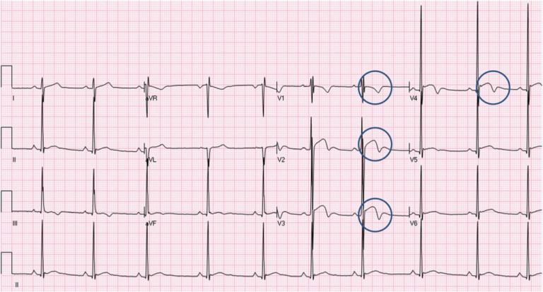 How would you interpret these T wave inversions? And what is an ...