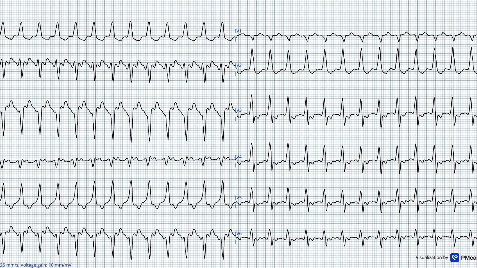 What do you make of these T wave inversions? - Dr. Smith’s ECG Blog