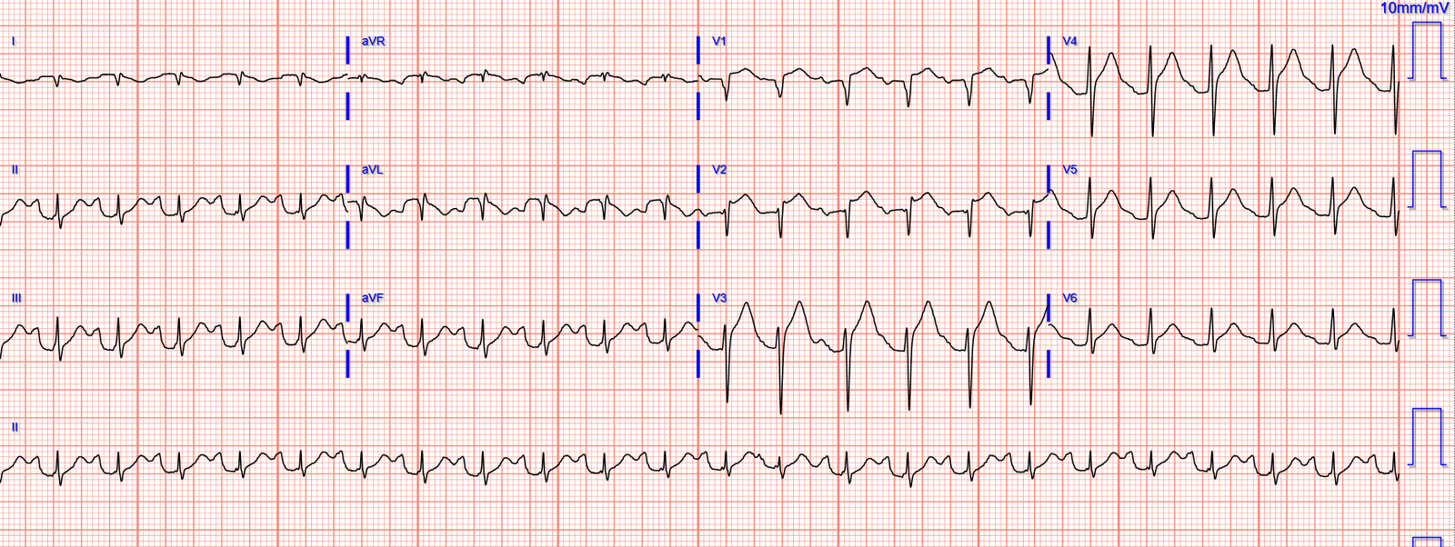 Altered Sign Wave Acute altered mental status, ST Elevation, Hyperacute T-waves, and ...