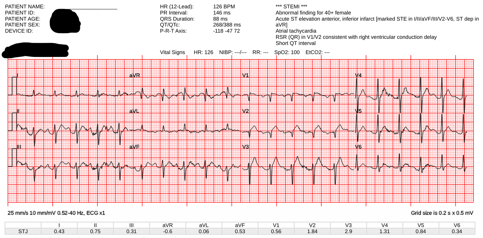 Acute altered mental status, ST Elevation, Hyperacute T-waves, and ...