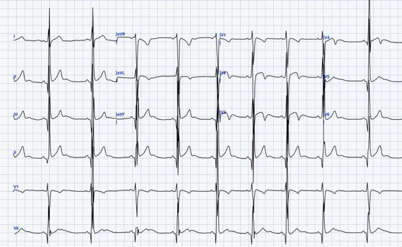 Absent T Wave How would you interpret these T wave inversions? And what is an ...