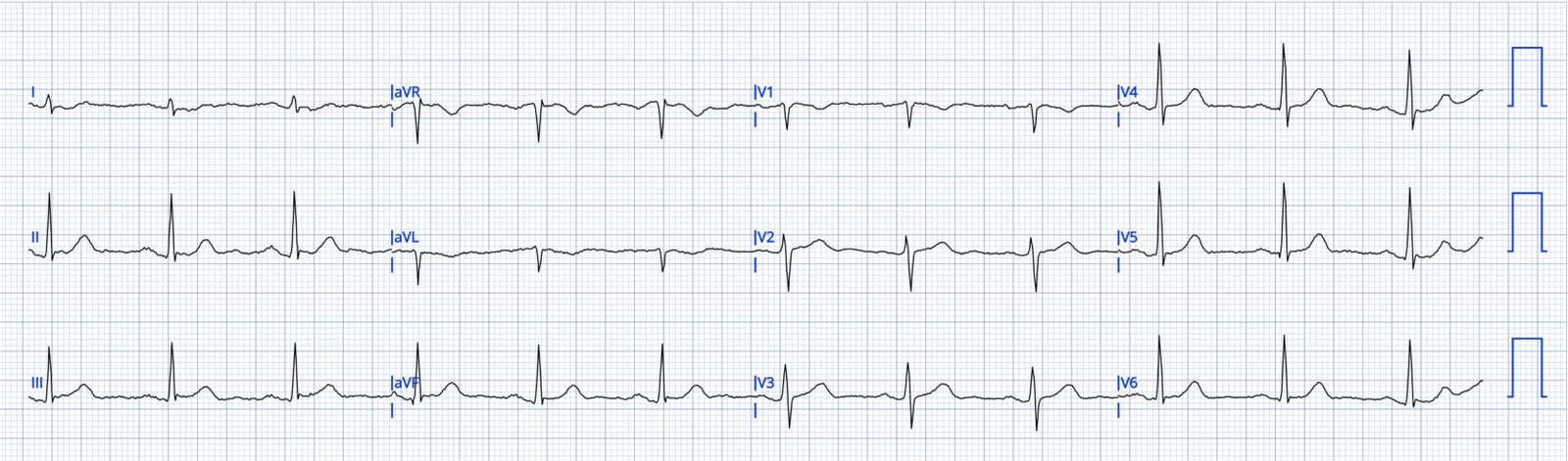 Chest pain in a 50-something. How important are serial ECGs in patients ...