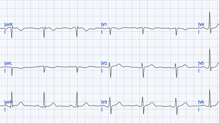Chest pain in a 50-something. How important are serial ECGs in patients ...