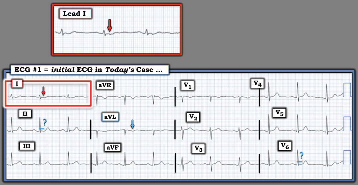 Chest pain in a 50-something. How important are serial ECGs in patients ...