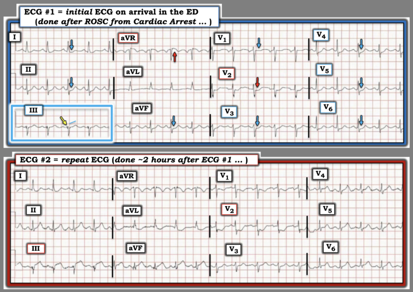 Stemi After Rosc STEMI: An Impossible Standard. NSTEMI: a worthless diagnosis. - Dr ...