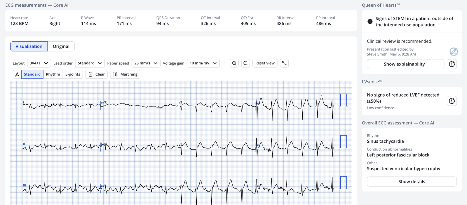 Altered Sign Wave Acute altered mental status, ST Elevation, Hyperacute T-waves, and ...