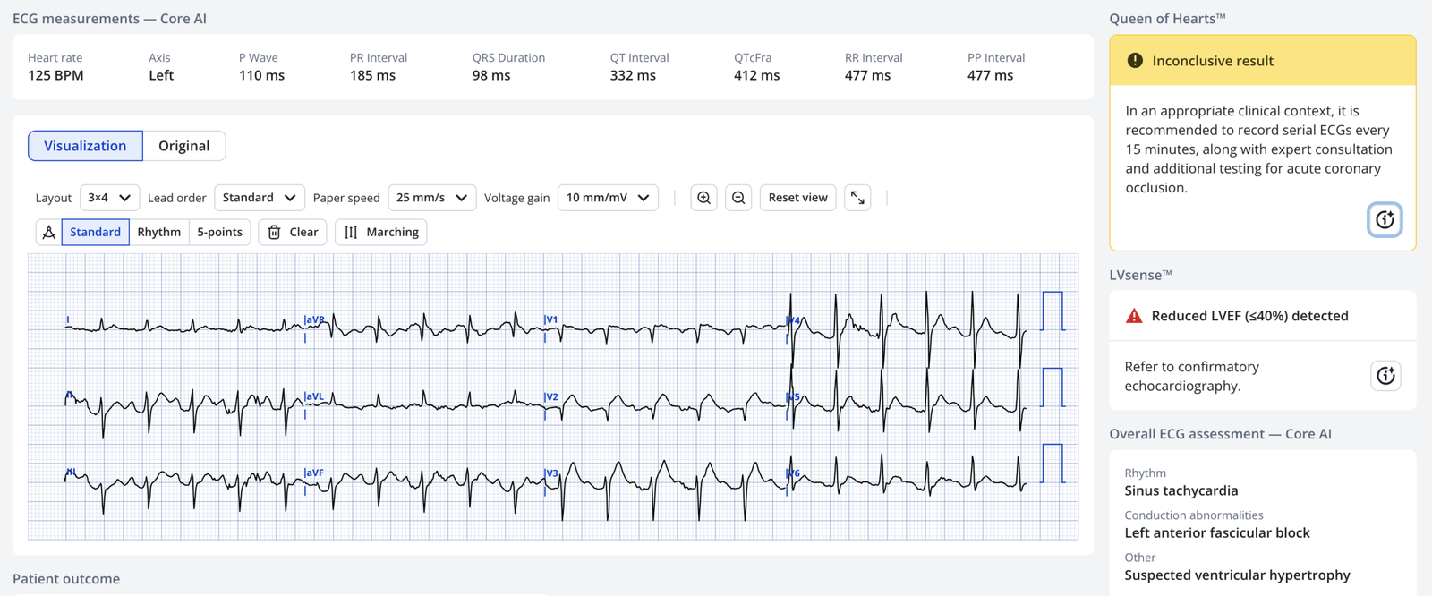 Altered Sign Wave Acute altered mental status, ST Elevation, Hyperacute T-waves, and ...