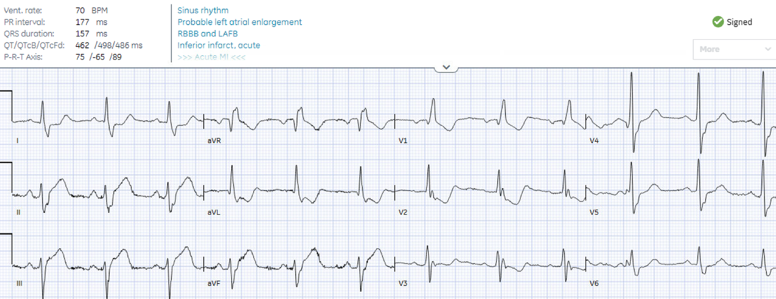 65 year old with acute abdominal pain: does lack of chest pain
